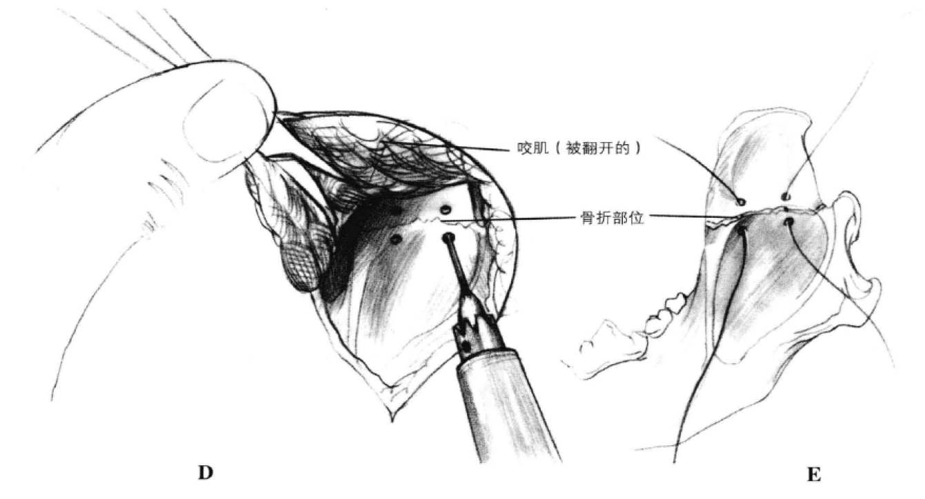 矫形钢丝固定术 蜜桃成品人视频入口