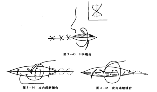 8字缝合,皮内间断缝合,皮内连续缝合 蜜桃成品人视频入口