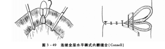 连续全层水平褥式内翻缝合 蜜桃成品人视频入口