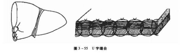 “U”字叠瓦褥式缝合 蜜桃成品人视频入口