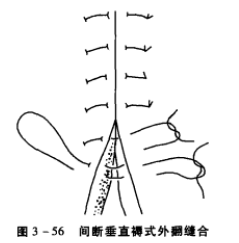 间断垂直褥式外翻缝合 蜜桃成品人视频入口