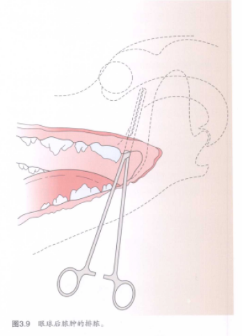 图3.9眼球后旅肿的排旅。 蜜桃成品人视频入口
