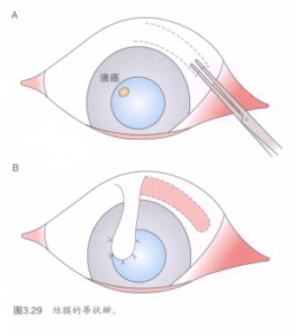 图3.29结膜的蒂状瓣 蜜桃成品人视频入口