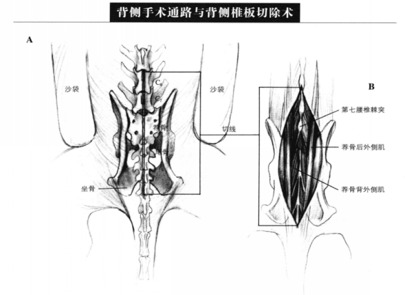 背侧手术通路与背侧椎板切除术 蜜桃成品人视频入口