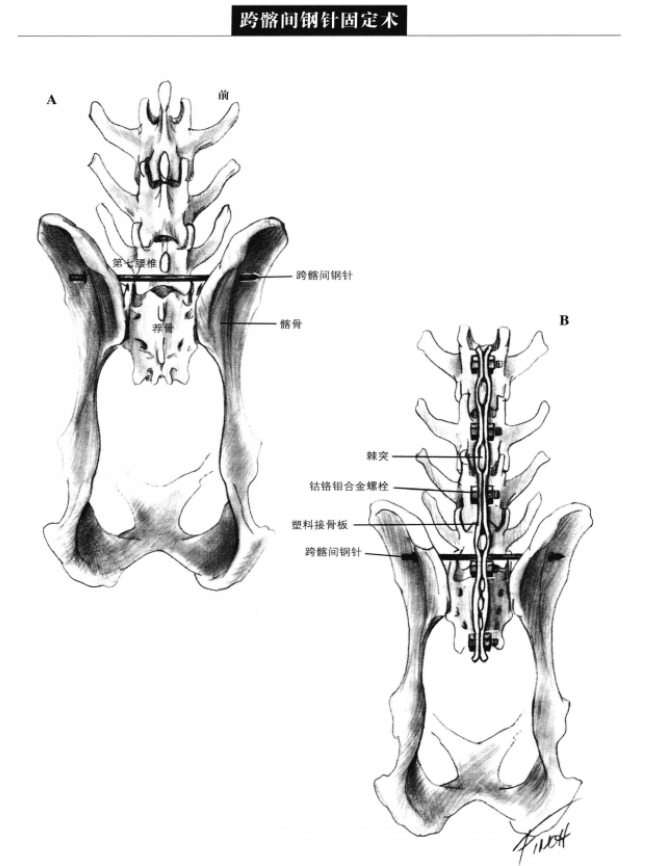 跨髂间钢针固定术 蜜桃成品人视频入口