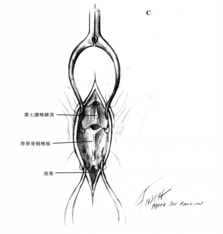 背侧手术通路与背侧椎板切除术 蜜桃成品人视频入口