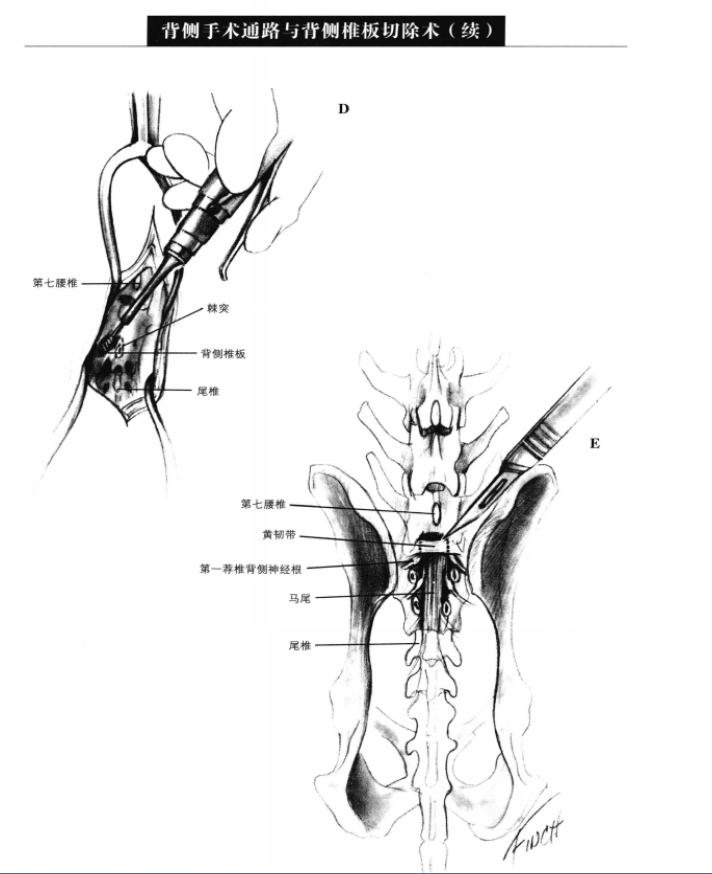 背侧手术通路与背侧椎板切除术 蜜桃成品人视频入口