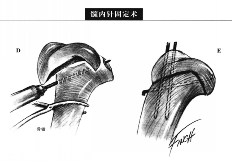 近端肱骨松质骨的采集 蜜桃成品人视频入口