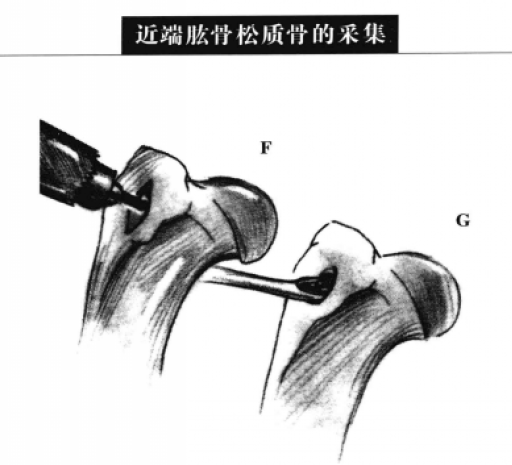 近端肱骨松质骨的采集 蜜桃成品人视频入口