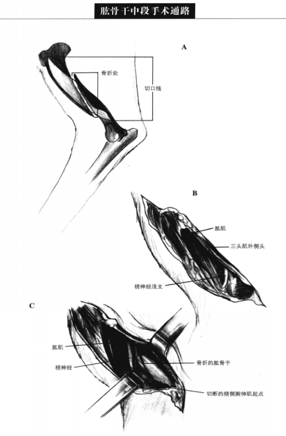 肱骨F中段手术通路 蜜桃成品人视频入口