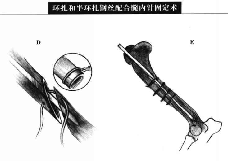 环扎和半环扎钢丝配合髓内针固定术 蜜桃成品人视频入口
