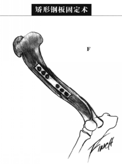 环扎和半环扎钢丝配合髓内针固定术 蜜桃成品人视频入口