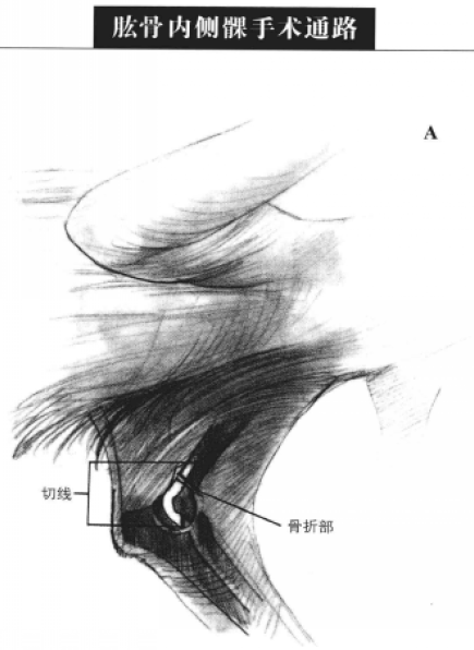 肱骨内侧髁手术通路 蜜桃成品人视频入口