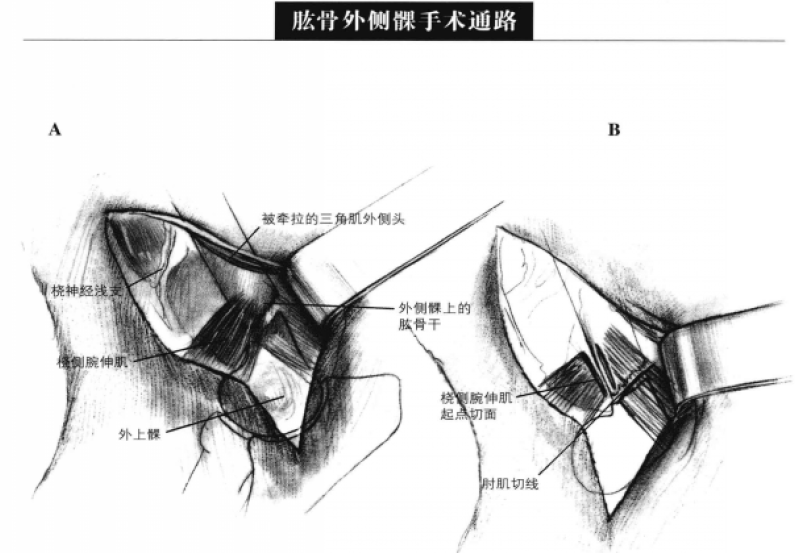 肱骨外侧髁于术通路 蜜桃成品人视频入口