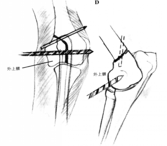 拉力螺钉固定术 蜜桃成品人视频入口