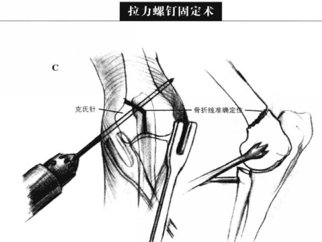 拉力螺钉固定术 蜜桃成品人视频入口