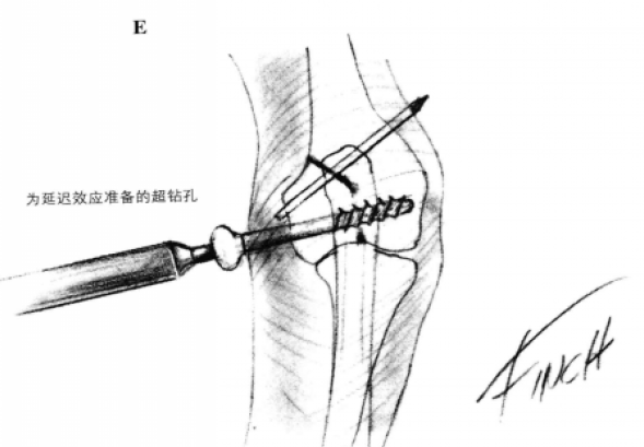 拉力螺钉固定术 蜜桃成品人视频入口
