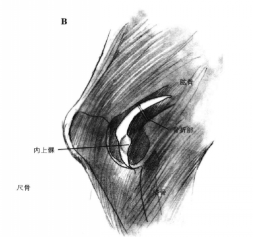 肱骨内侧髁手术通路 蜜桃成品人视频入口