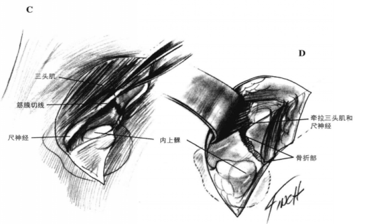 肱骨内侧髁手术通路 蜜桃成品人视频入口