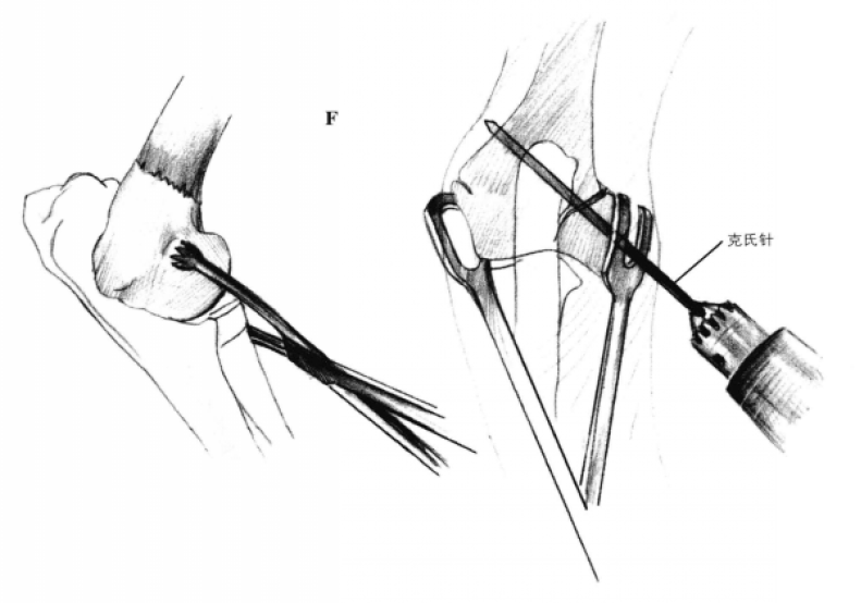 拉力螺钉固定术 蜜桃成品人视频入口
