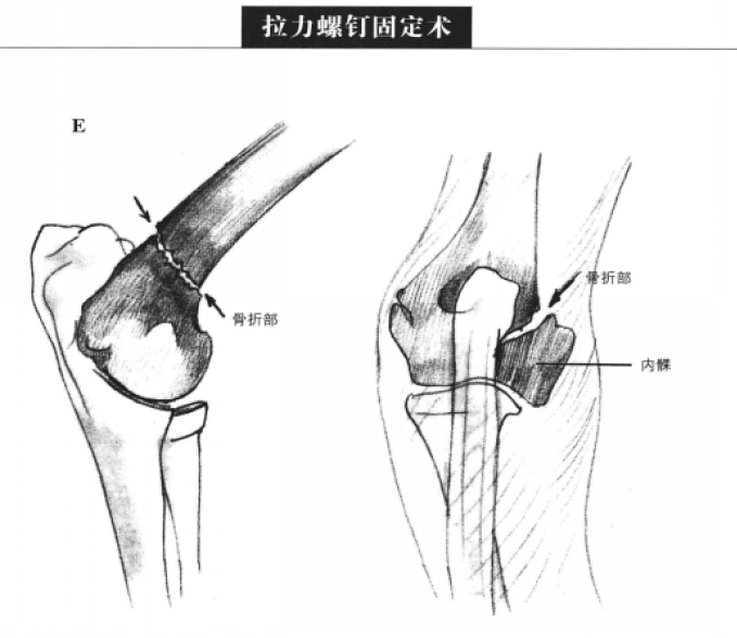 拉力螺钉固定术 蜜桃成品人视频入口