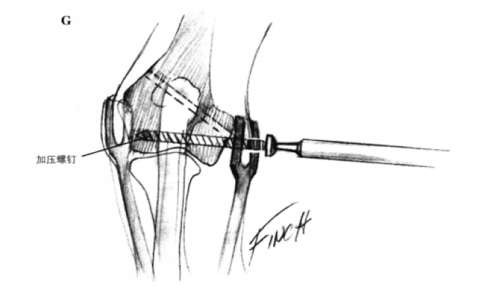 拉力螺钉固定术 蜜桃成品人视频入口