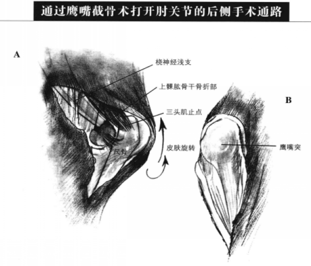 通过鹰嘴截骨术打开肘关节的后侧手术通路 蜜桃成品人视频入口