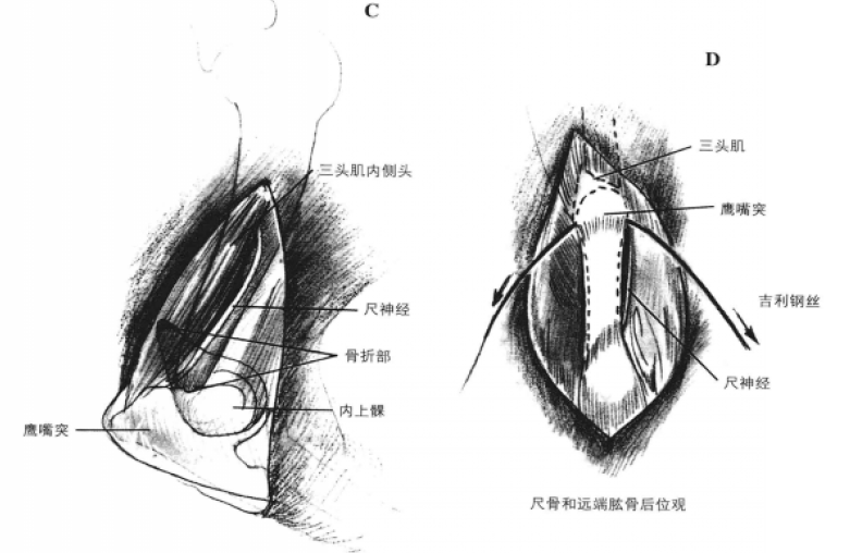 通过鹰嘴截骨术打开肘关节的后侧手术通路 蜜桃成品人视频入口