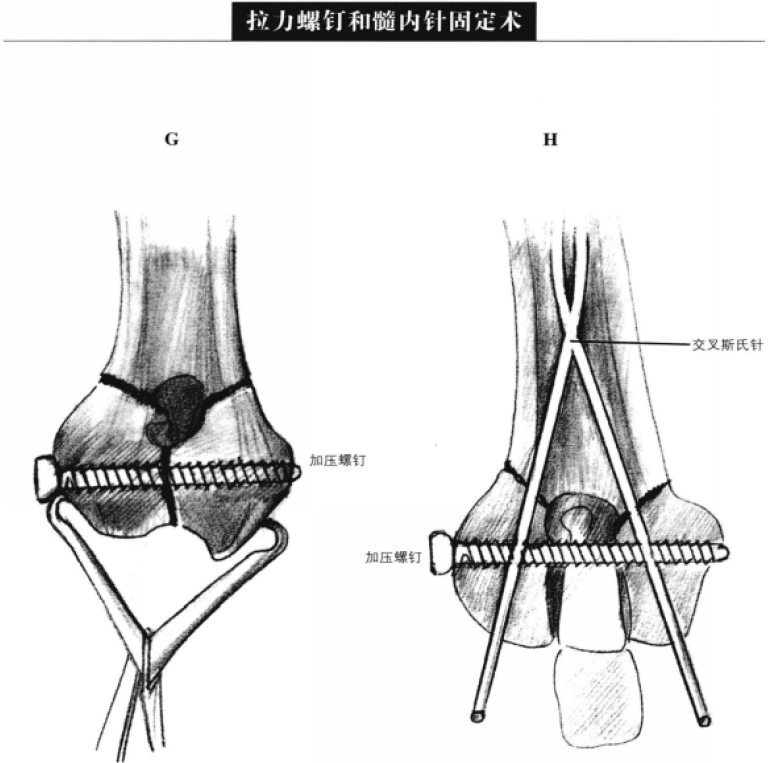 拉力螺钉和髓内针固定术 蜜桃成品人视频入口