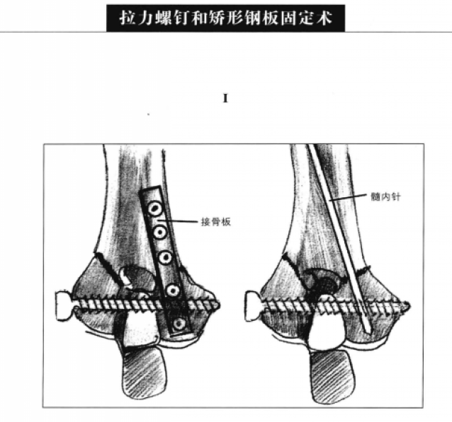 拉力螺钉和髓内针固定术 蜜桃成品人视频入口