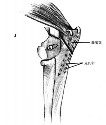 拉力螺钉和矫形钢板固定术 蜜桃成品人视频入口