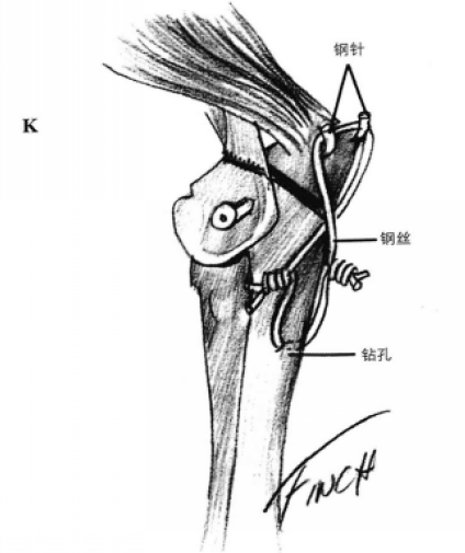 拉力螺钉和矫形钢板固定术 蜜桃成品人视频入口