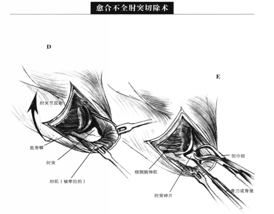 愈合不全肘突切除术 蜜桃成品人视频入口