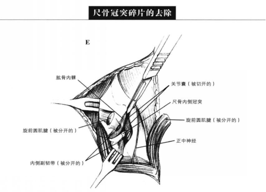 尺骨冠突碎片的去除 蜜桃成品人视频入口