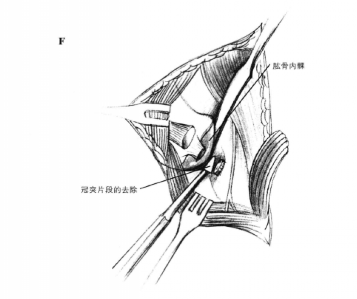 尺骨冠突碎片的去除 蜜桃成品人视频入口