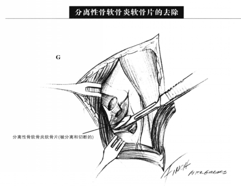 尺骨冠突碎片的去除 蜜桃成品人视频入口