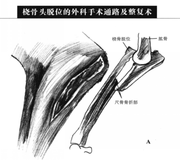 桡骨头脱位的外科手术通路及整复术 蜜桃成品人视频入口