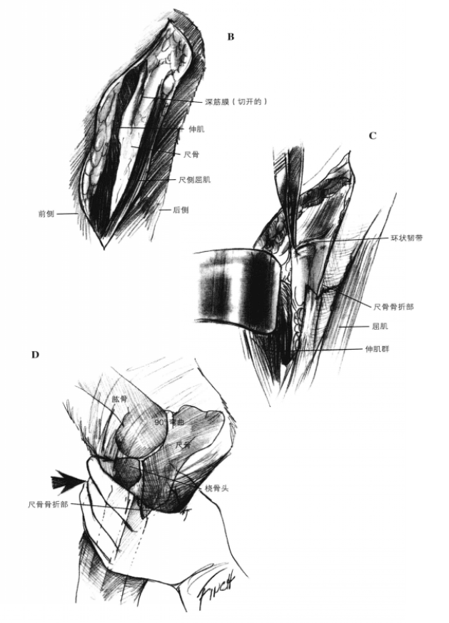 桡骨头脱位的外科手术通路及整复术 蜜桃成品人视频入口