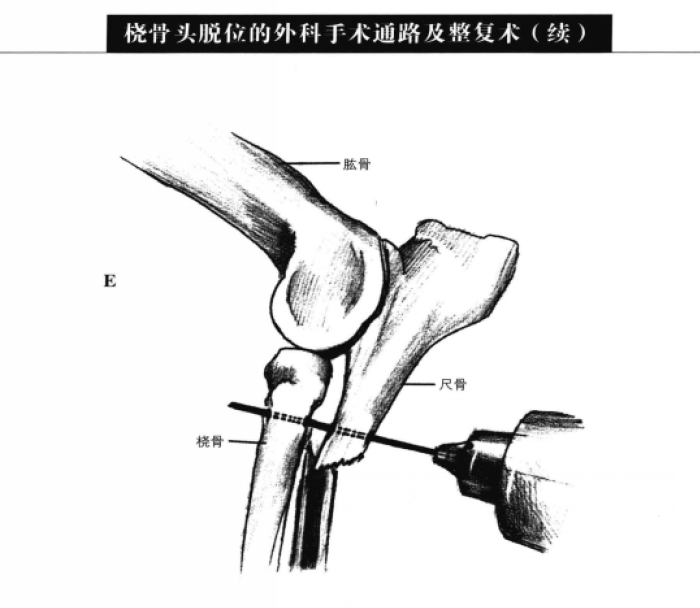 矫形钢板和拉力螺钉固定术 蜜桃成品人视频入口