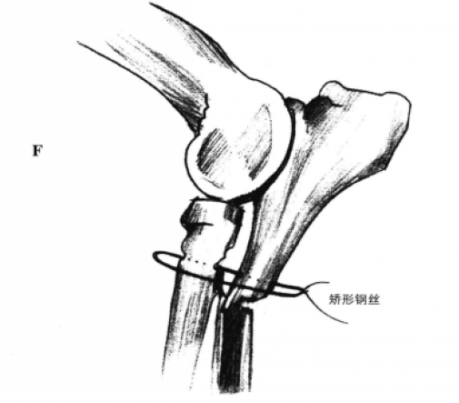 矫形钢板和拉力螺钉固定术 蜜桃成品人视频入口