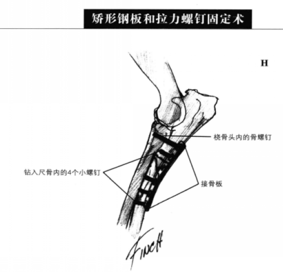 矫形钢板和拉力螺钉固定术 蜜桃成品人视频入口