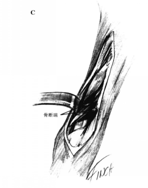 桡骨干前外侧手术通路 蜜桃成品人视频入口