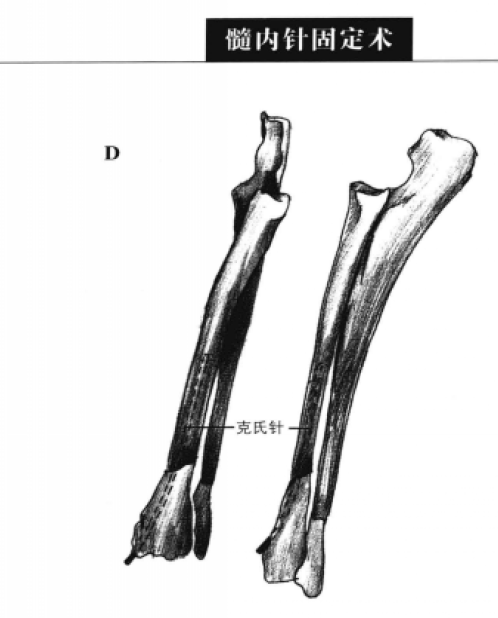 髓内针固定术 蜜桃成品人视频入口