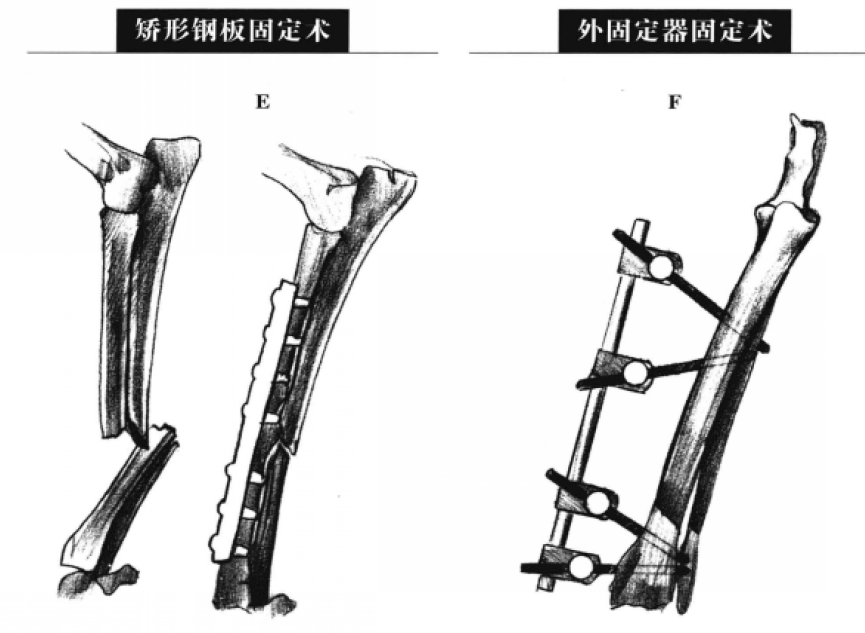 外固定器固定术 蜜桃成品人视频入口