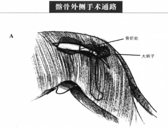 髂骨外侧手术通路 蜜桃成品人视频入口