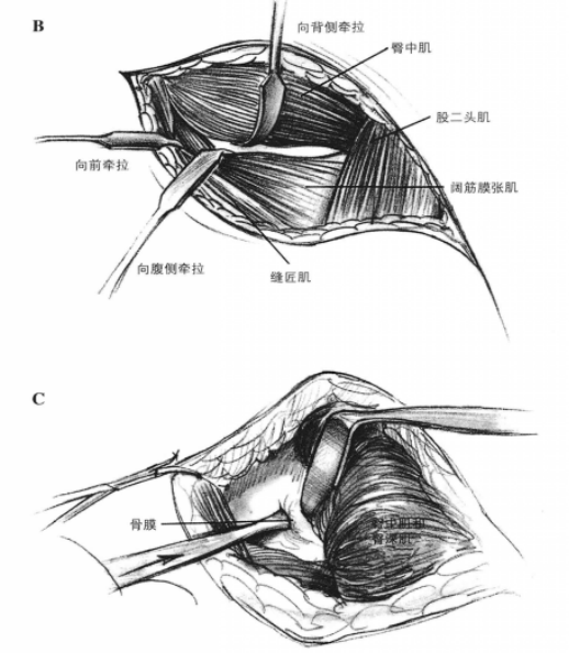 髂骨外侧手术通路 蜜桃成品人视频入口
