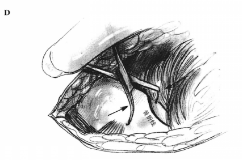 髂骨外侧手术通路 蜜桃成品人视频入口