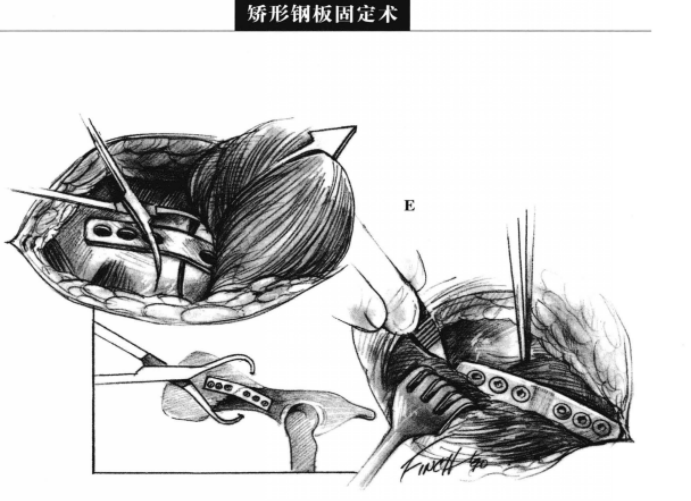 矫形钢板固定术 蜜桃成品人视频入口