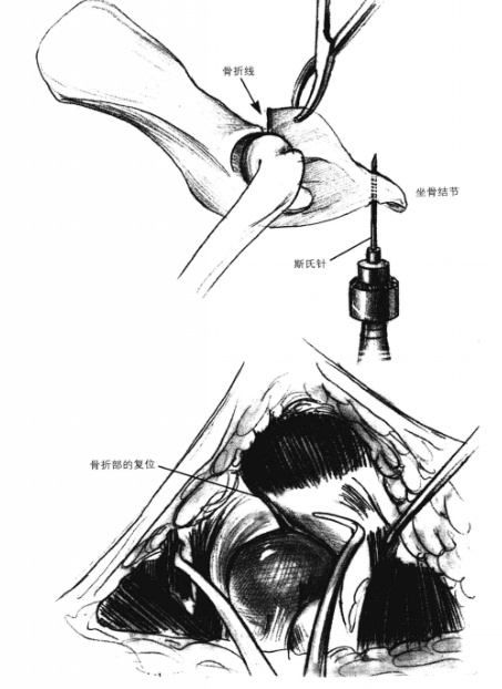 矫形钢板固定术 蜜桃成品人视频入口