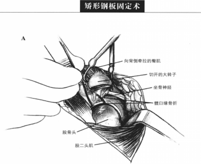 矫形钢板固定术 蜜桃成品人视频入口
